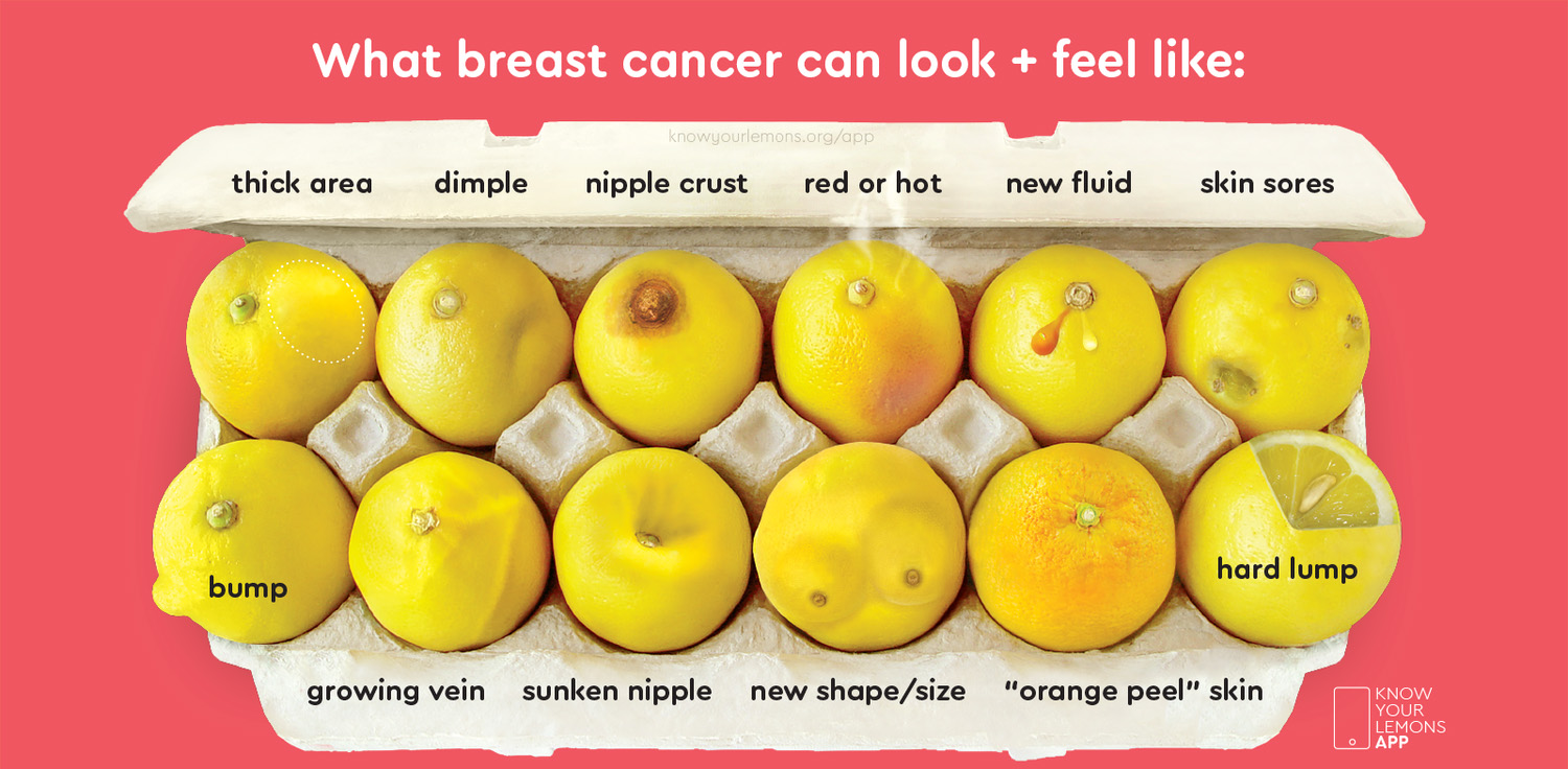 Graph is what breast cancer can look and feel like